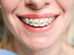 Tipos de Ortodoncia: innovación tecnológica en tu sonrisa