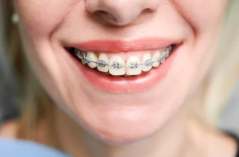 Tipos de Ortodoncia: innovación tecnológica en tu sonrisa