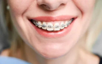 Tipos de Ortodoncia: innovación tecnológica en tu sonrisa