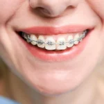 brackets metálicos, uno de los tipos de ortodoncia más utilizados